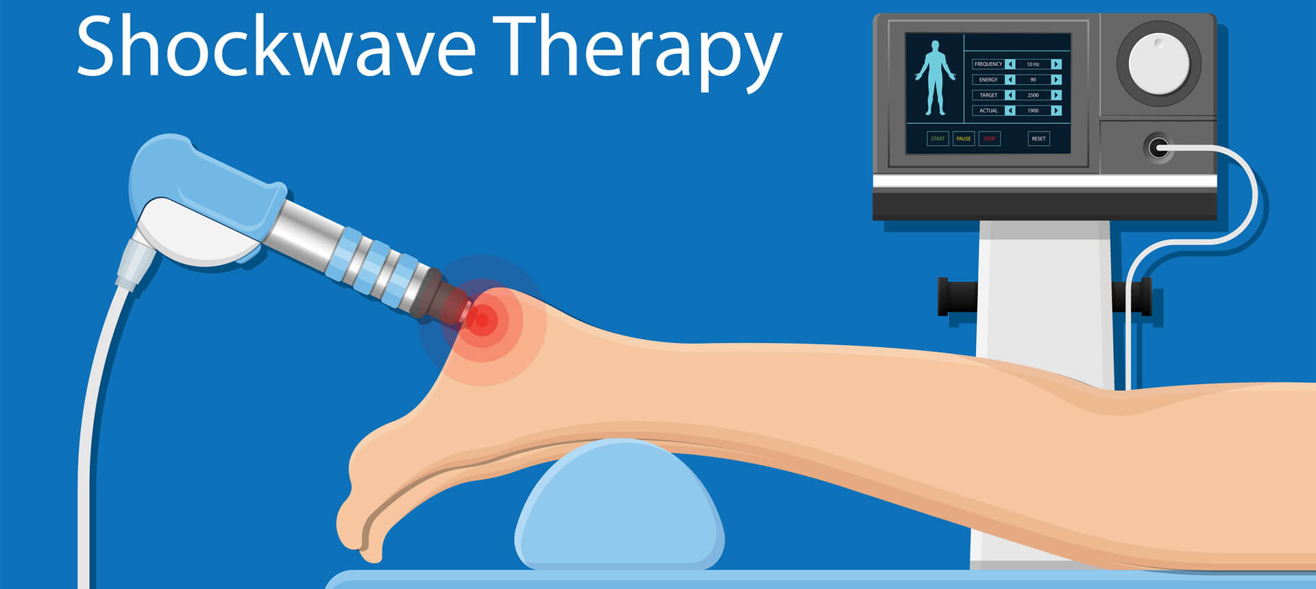 shockwave therapy